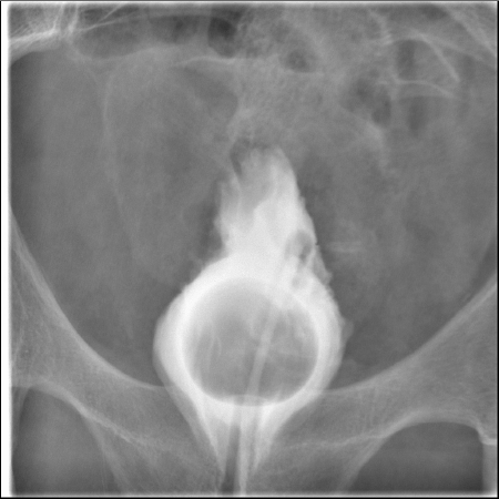 Fluoroscopy example - cystogram